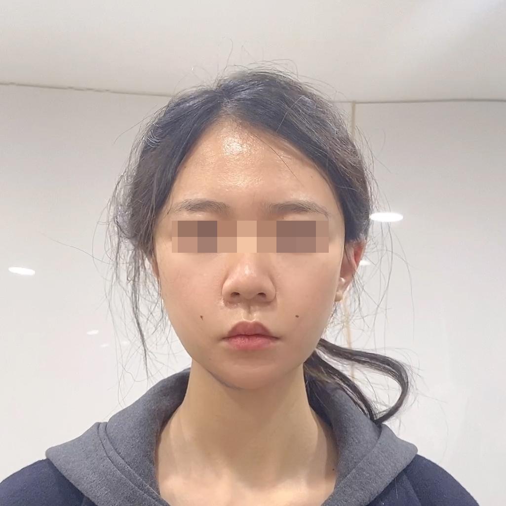 30岁女人做脸部美容,脸部面吸手术后的真实感受