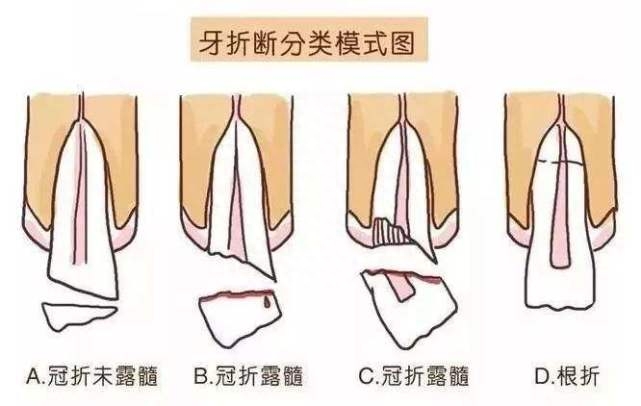 大牙崩掉一小块怎么办,补过的牙侧面被崩掉了一块怎么办