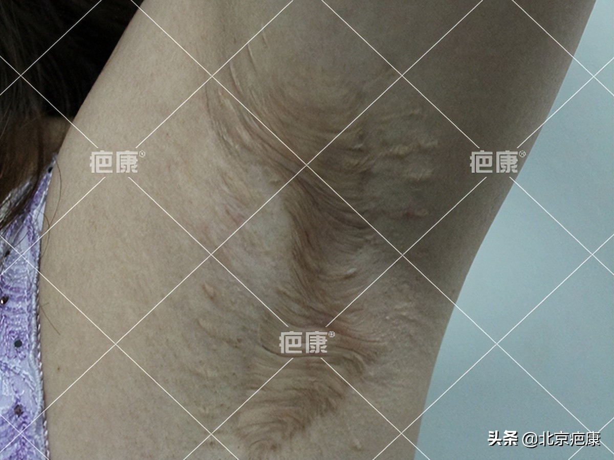 手术后刀口增生怎么办,做完腋下手术后留疤