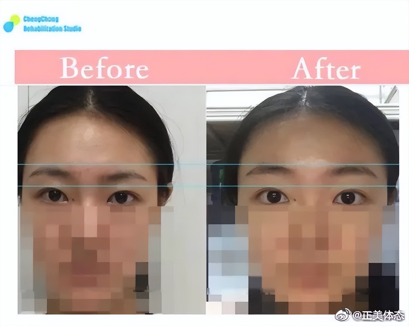 单眼皮大小眼怎么解决,怎么告别大小眼