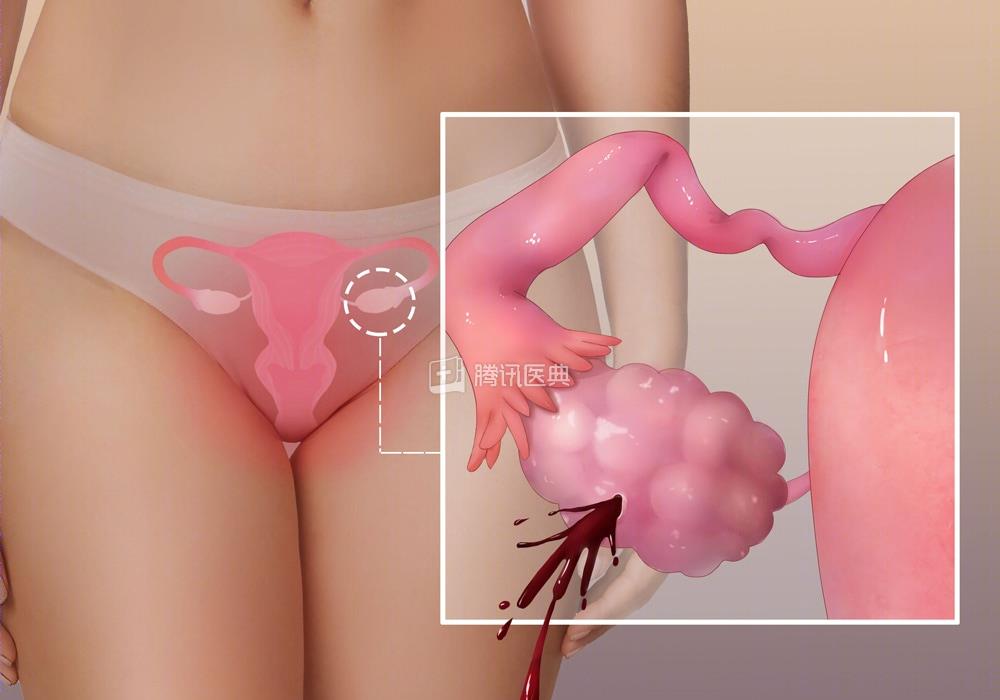 20岁女大学生“捐卵”差点死了，但很多人从中赚钱。