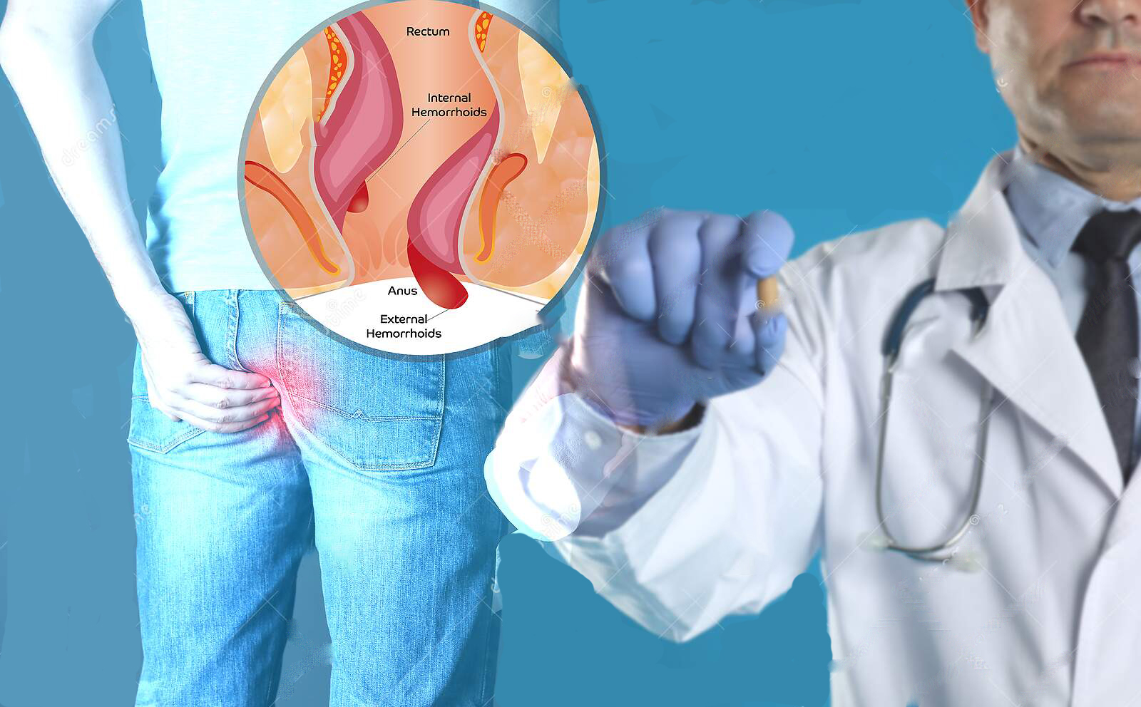 痔疮真的是十男九痔吗,痔疮十男九痔