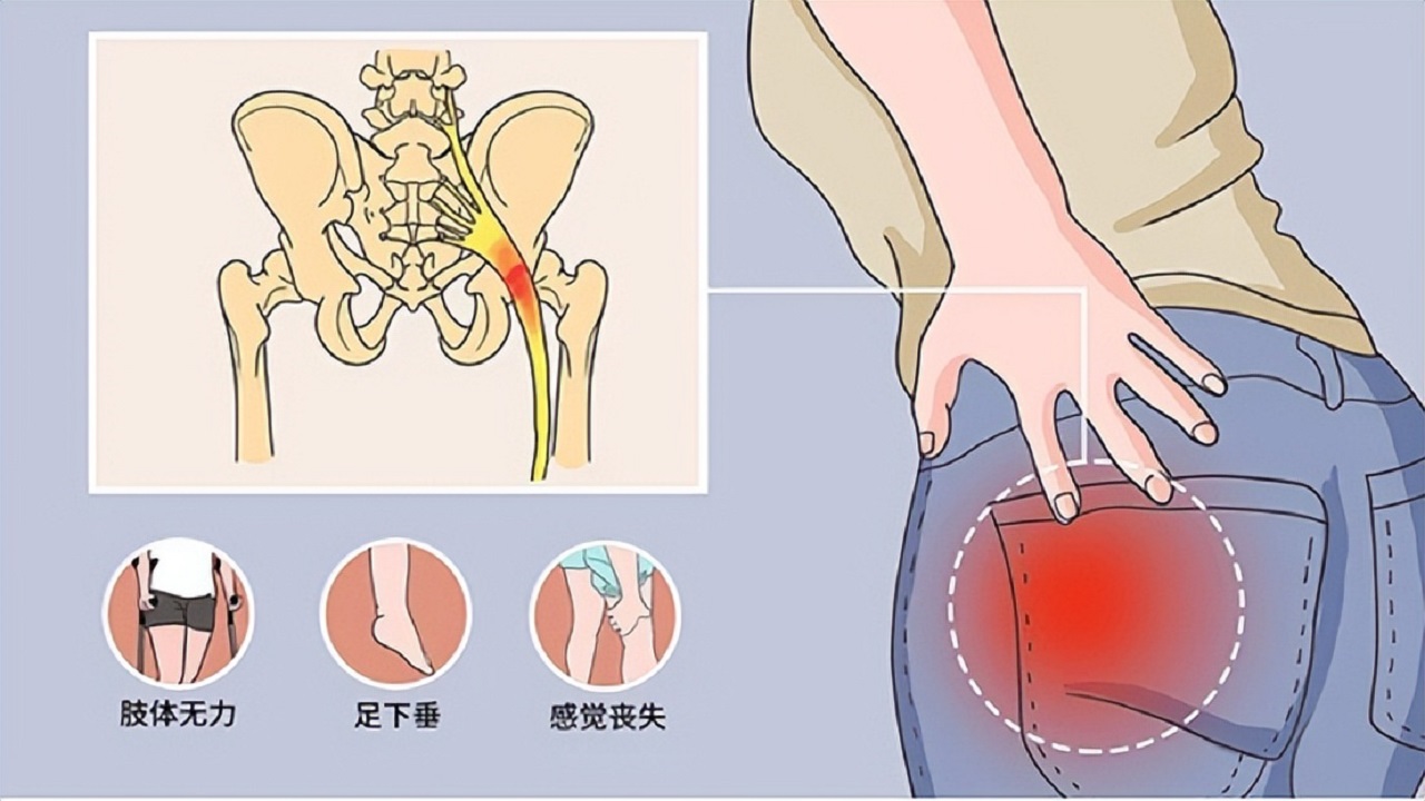 甲钴胺片治疗腰椎突出好吗,甲钴胺治疗腰椎间盘突出要吃多久