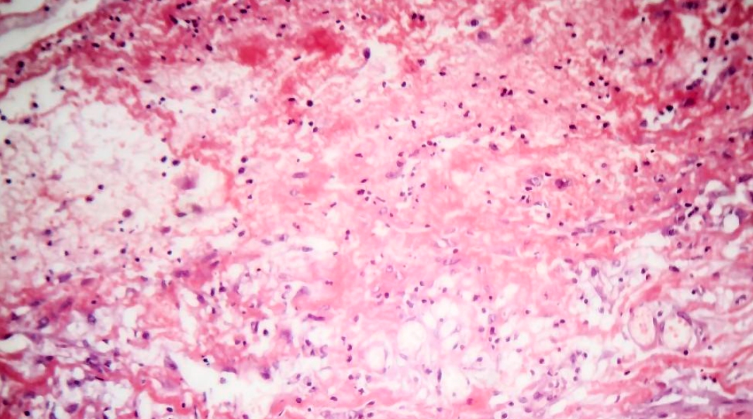 朊病毒致死率100%!无药可救烹煮杀不死，感染后到底有多恐怖？