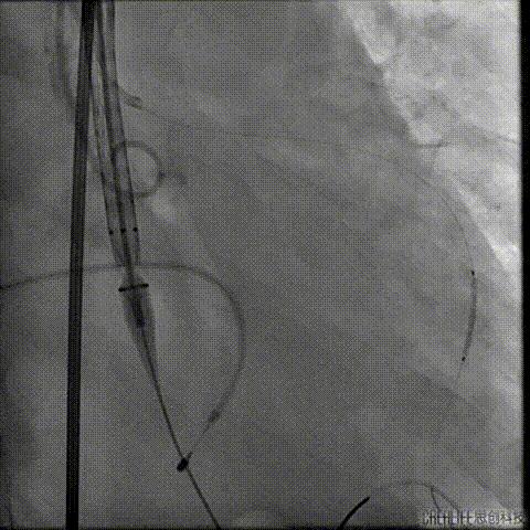 病例回顾与分享,腹膜后血肿介入治疗