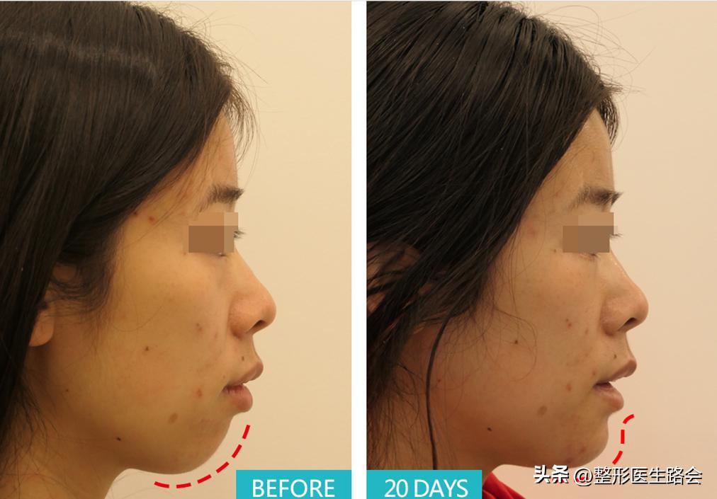 做假体下巴后的真实感受,做了假体下巴很后悔