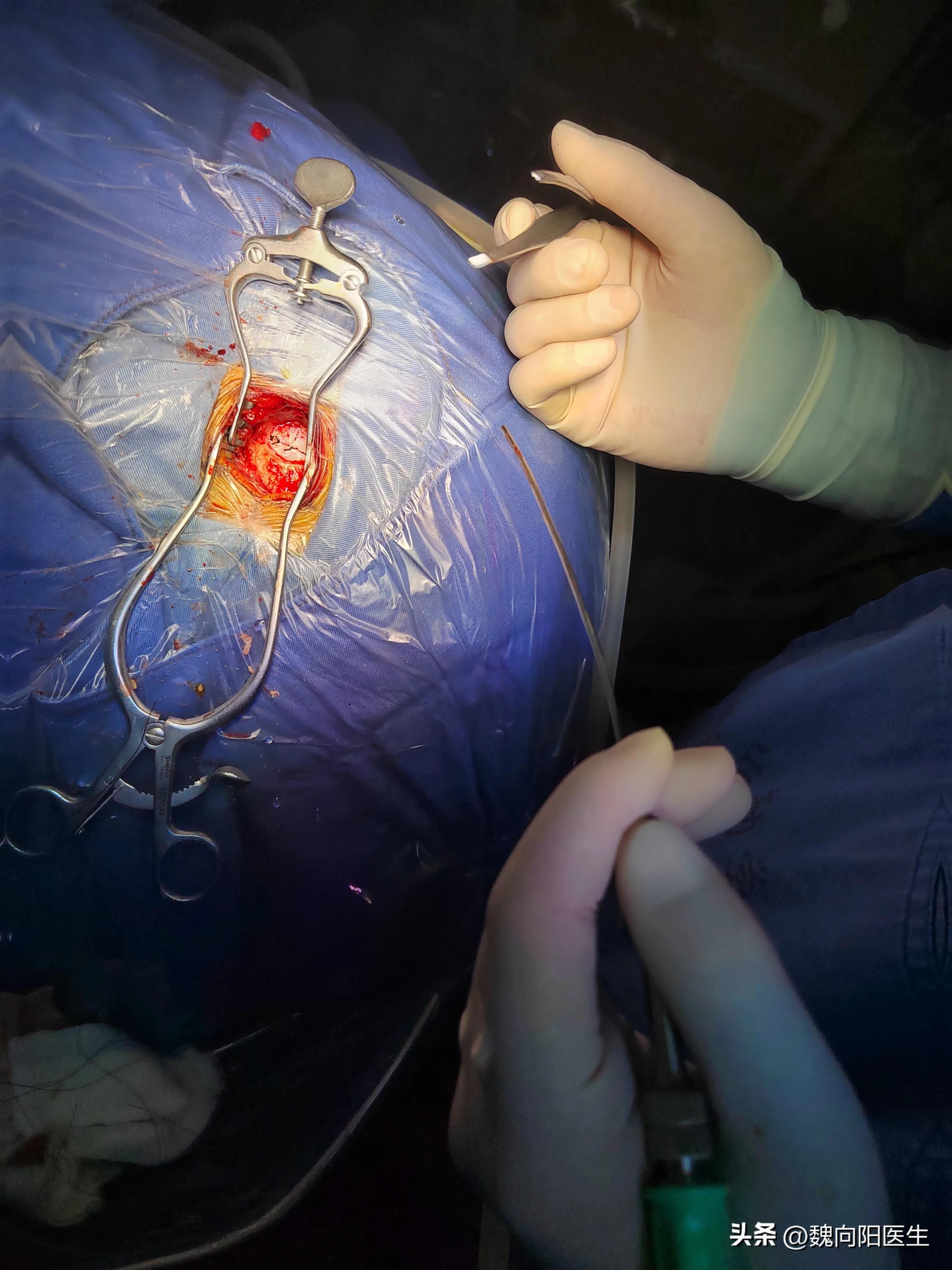 三叉神经痛可以针灸治疗吗,三叉神经痛是什么位置图片