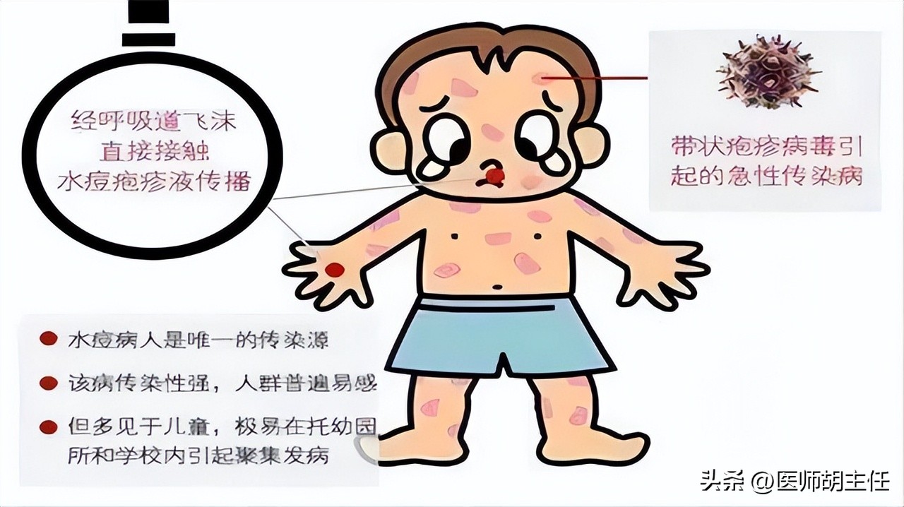 带状疱疹令人疼痛难忍该如何预防,哪些是带状疱疹患者要纠正的误区