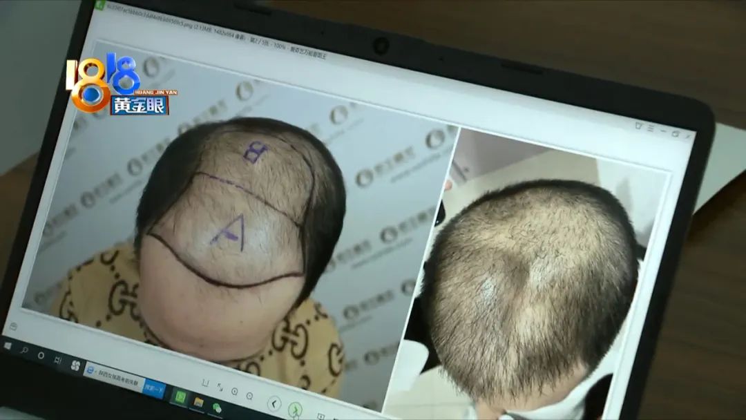 现在植发存活率高吗,68岁女性可以植发吗成活率有多高