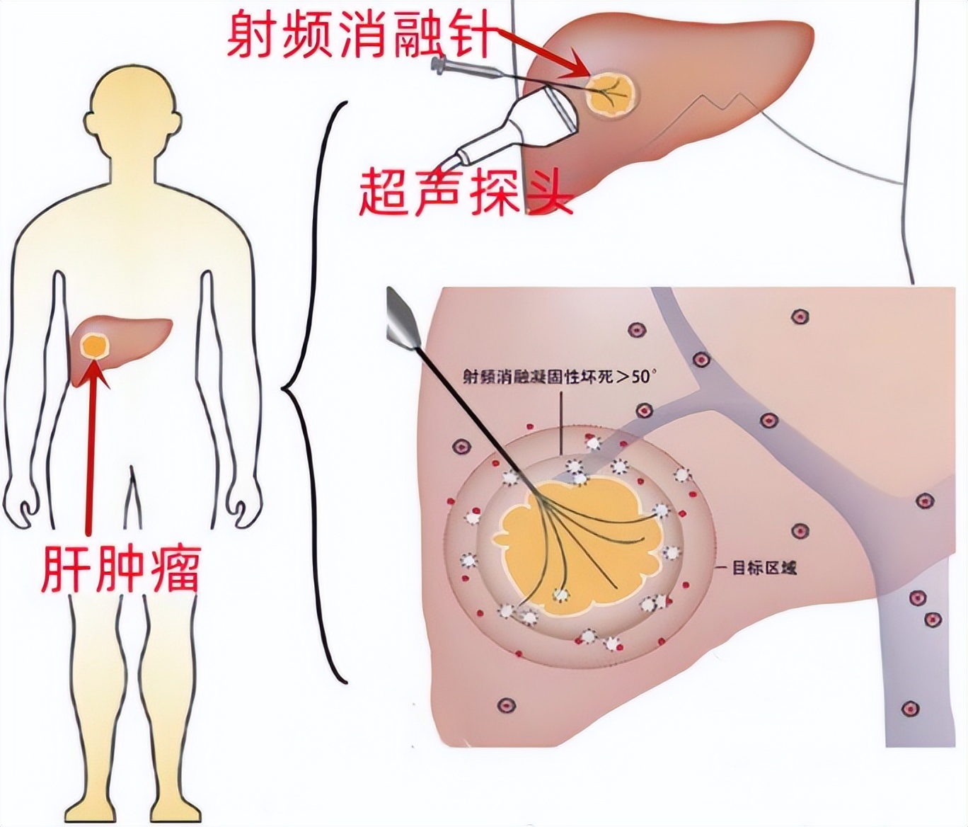 什么肝癌适合射频消融治疗,射频消融治疗肝癌适应症