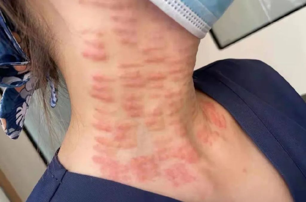 打完嗨体颈纹凸起一月,打了四针颈纹凸起