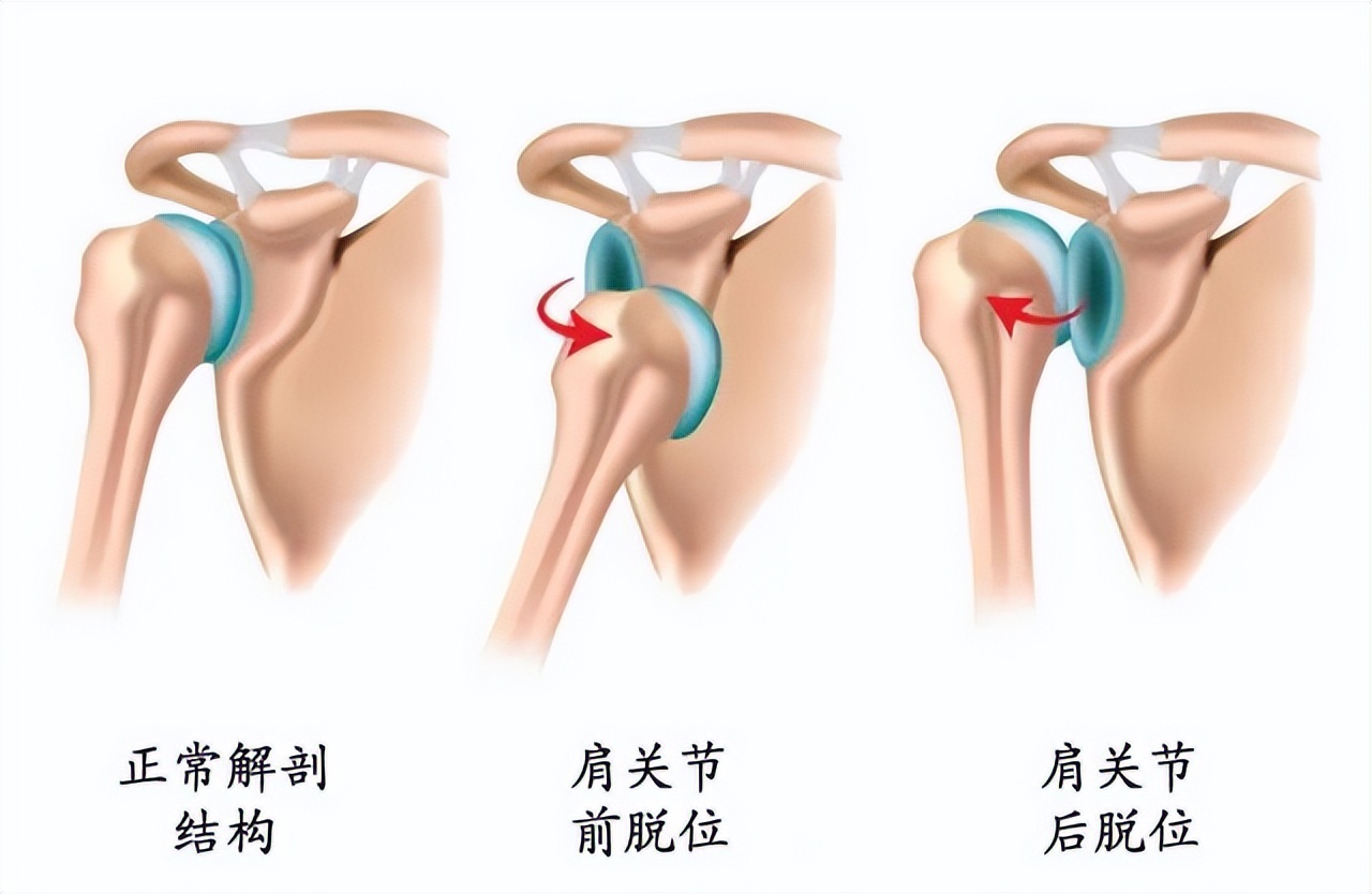 肩关节解剖及常见疾病的磁共振,肩关节常见病图解