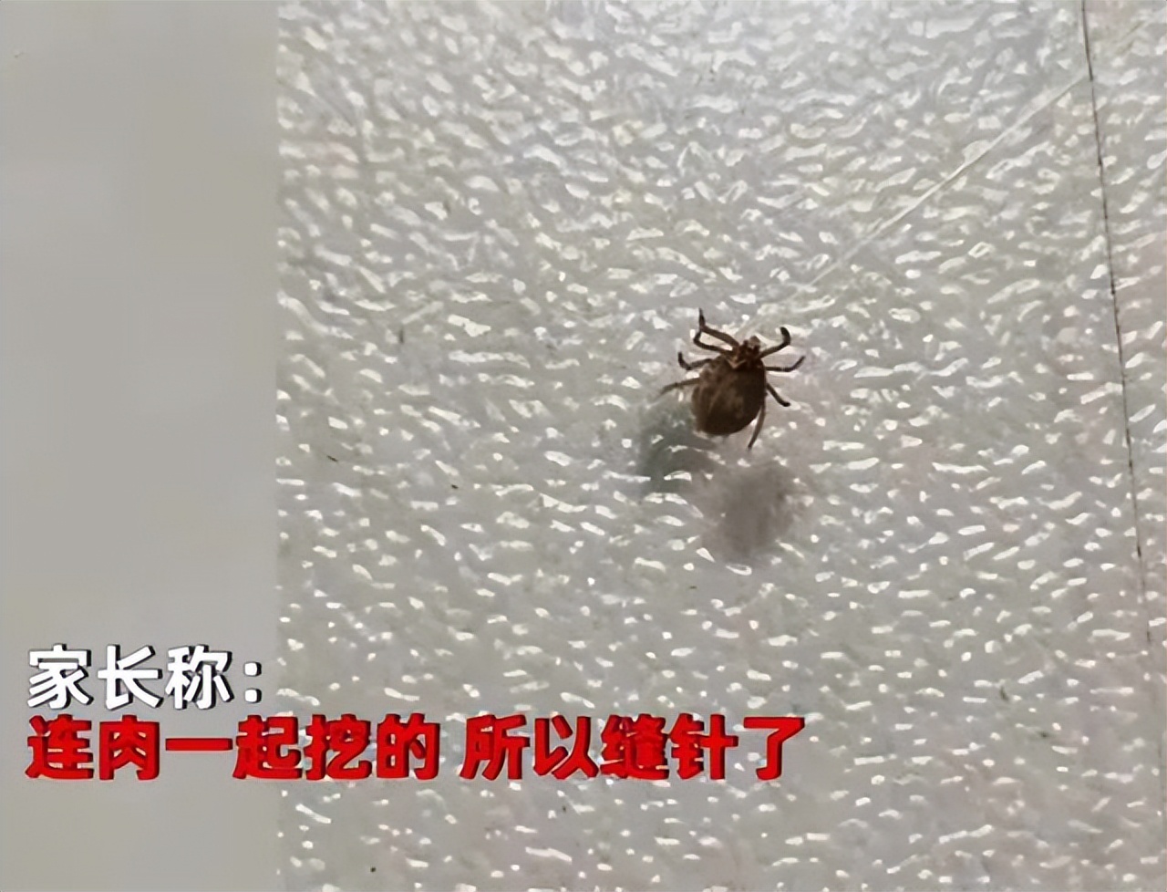 妈妈帮孩子理发发现蜱虫,小孩儿头上发现有蜱虫