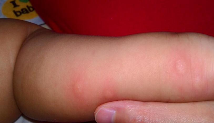 10个月宝宝腿上长了个硬包块,100天宝宝腿上突然长很多疙瘩