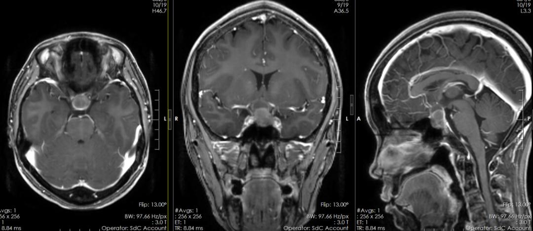 30岁就“停经”正常吗？警惕垂体瘤