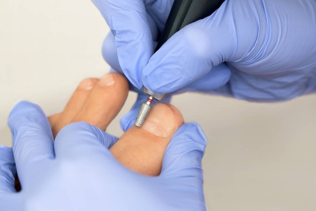 脚趾甲老往肉里长，得了“嵌甲”怎么办？医生：你需要了解这3点