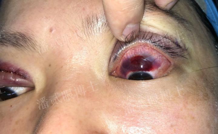 双眼皮修复潘贰博士地址,双眼皮失败二次修复视频