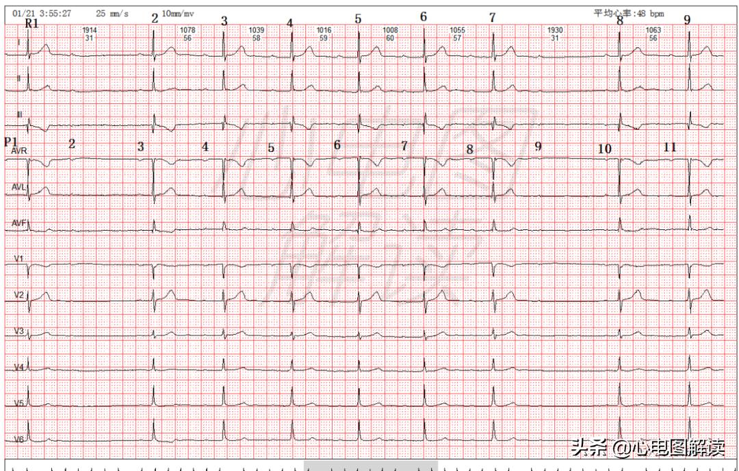 心电图rr间期长有危害吗,心电图短pr间期产生原因