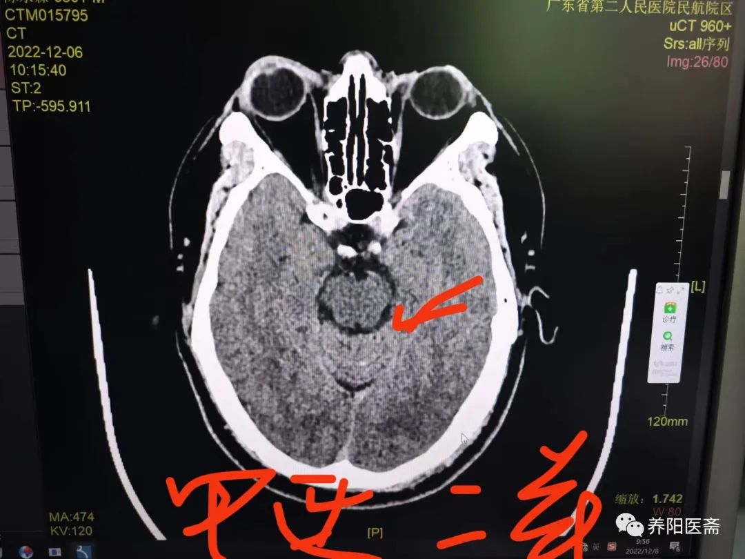 右丘脑出血出现偏瘫说不出来话,脑卒中走路不稳能恢复吗