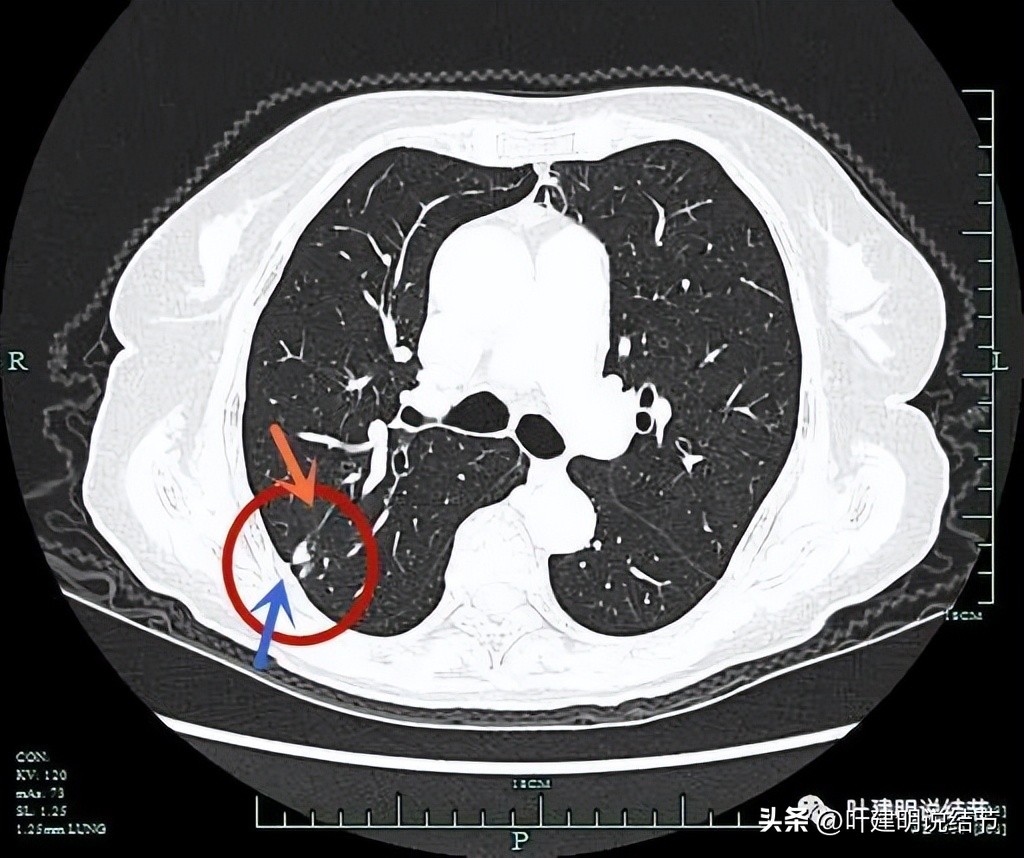 79岁肺癌早期手术风险,75岁早期浸润性肺癌还要治疗吗