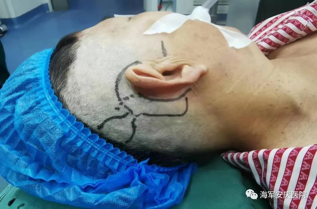 神经性耳聋配的人工耳蜗,感音神经性耳聋可以做人工耳蜗吗