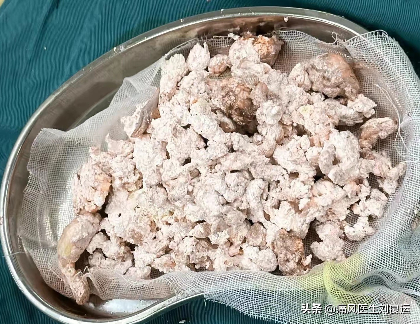 痛风男性千万别吃三种蔬菜,男子痛风长期吃止痛药