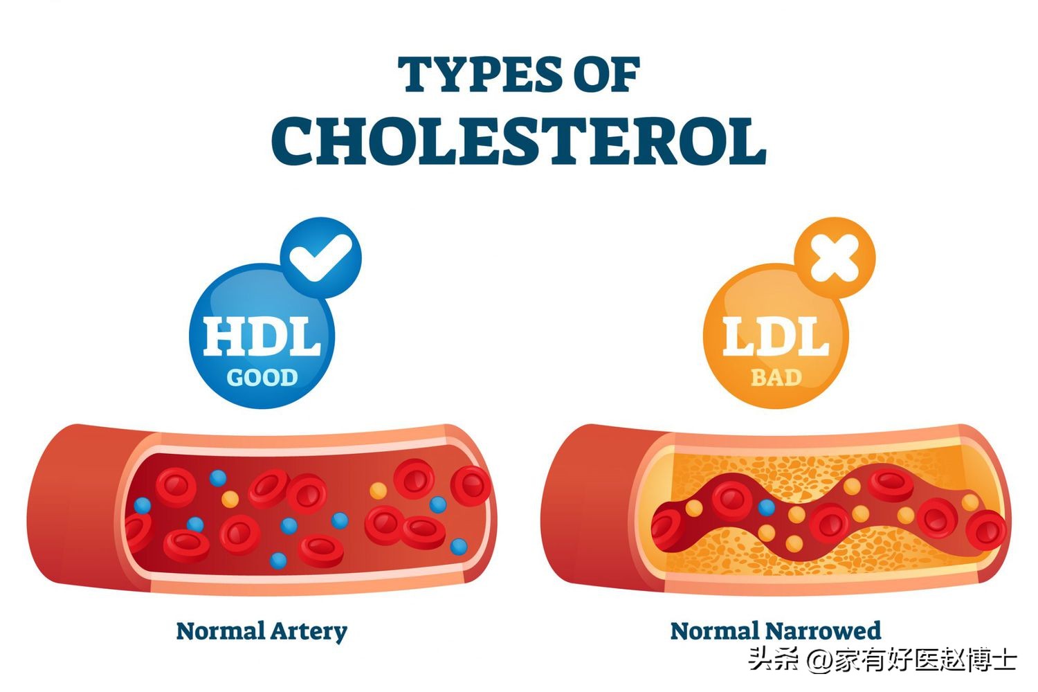 低密度胆固醇ldl偏高需要注意什么,hdl胆固醇偏低是什么意思