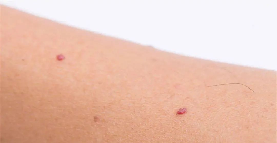 身上长出不痛不痒的血痣，别大意，1张方子疏肝解郁，帮你调理