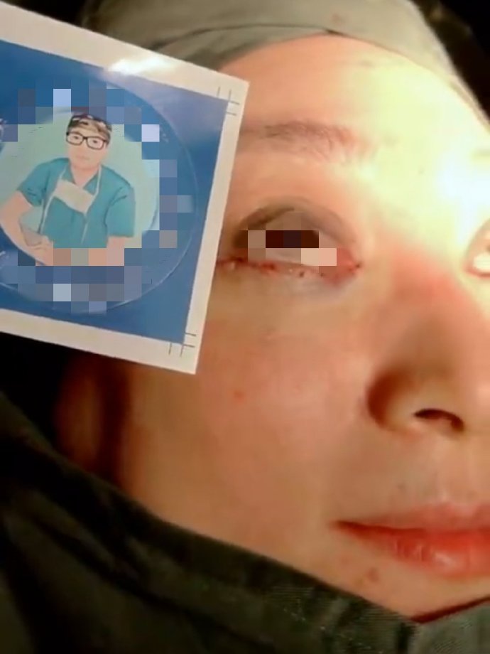 外切祛眼袋1-7天恢复图真人,外切祛眼袋恢复过程