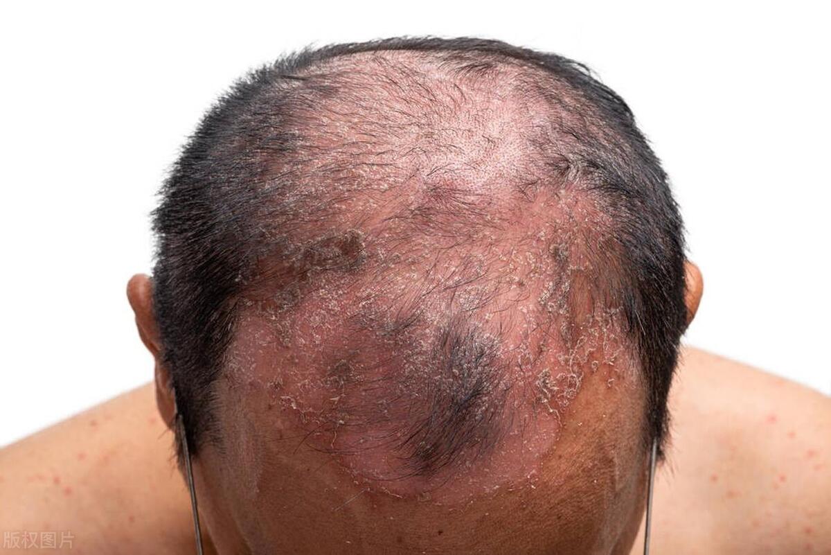 治牛皮癣的药可以治头癣吗,牛皮癣和头癣的区别