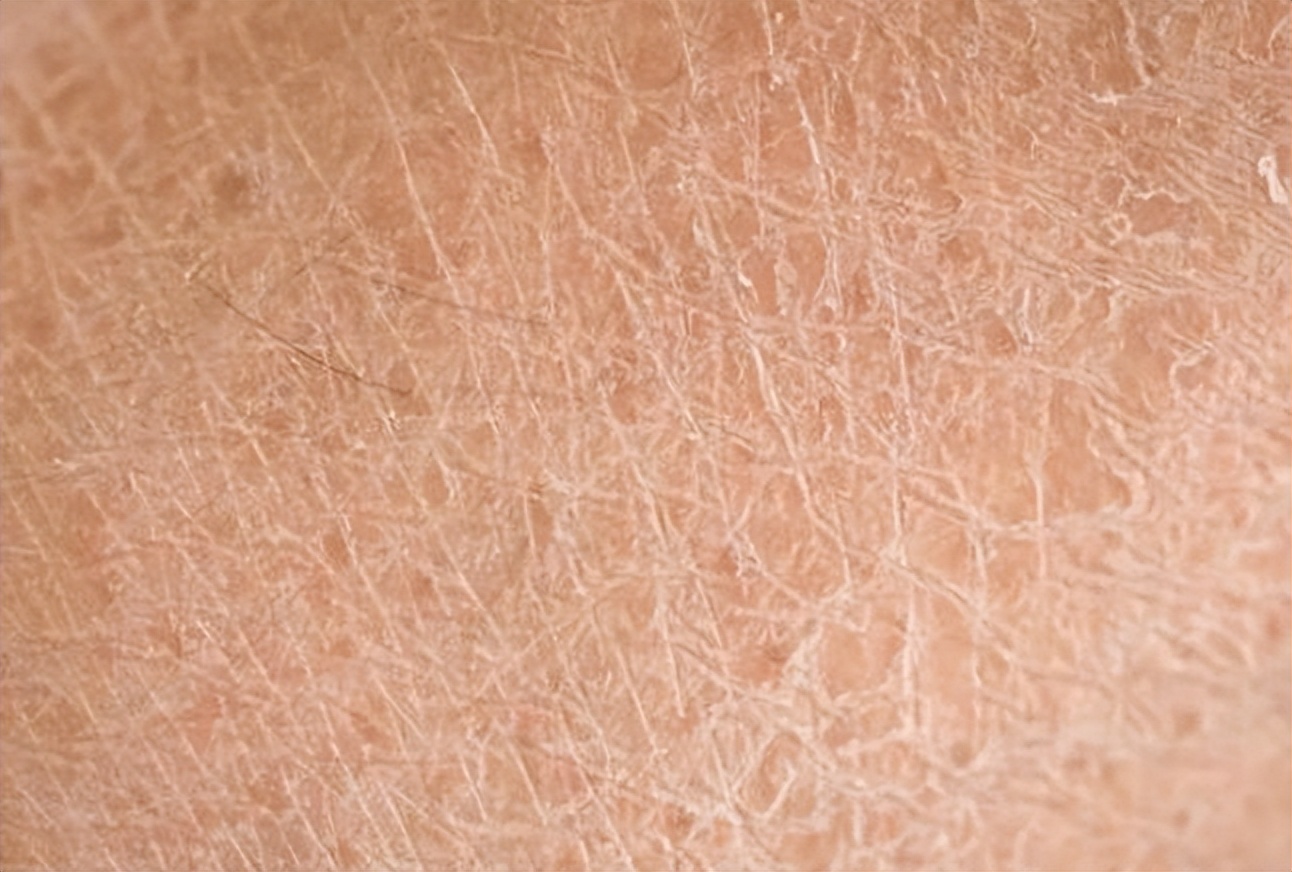 冬季皮肤干燥起皮有纹,皮肤干燥起蛇皮纹