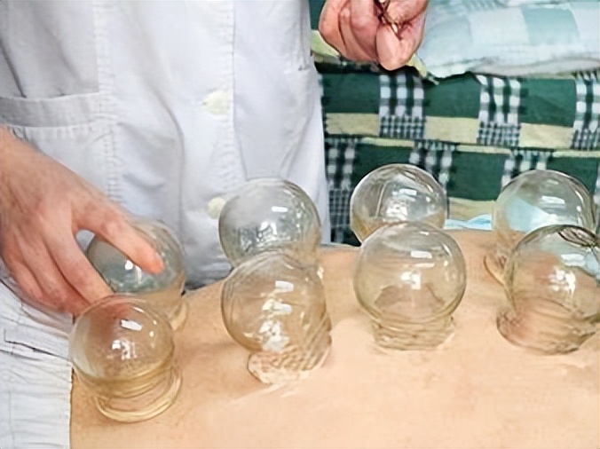 拔火罐吸出来的是湿气还是毒素,拔火罐吸出来的淤血是什么