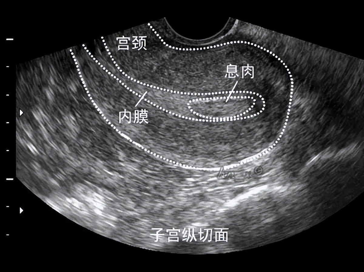 出血不止有血块是什么原因,排卵期出血跟子宫内膜息肉有关吗