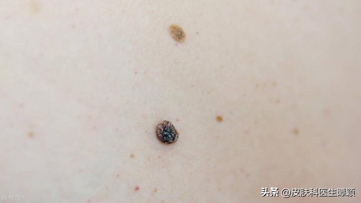 什么样的色素痣要去掉,什么样的色素痣要去除