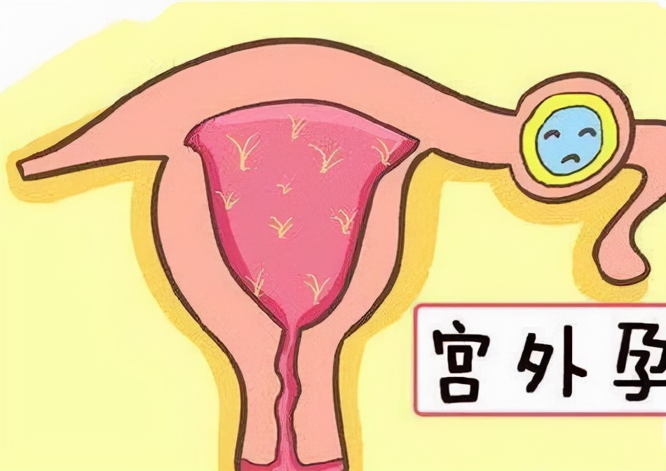 为什么宫外孕的发病率逐年增高,宫外孕的比例高吗