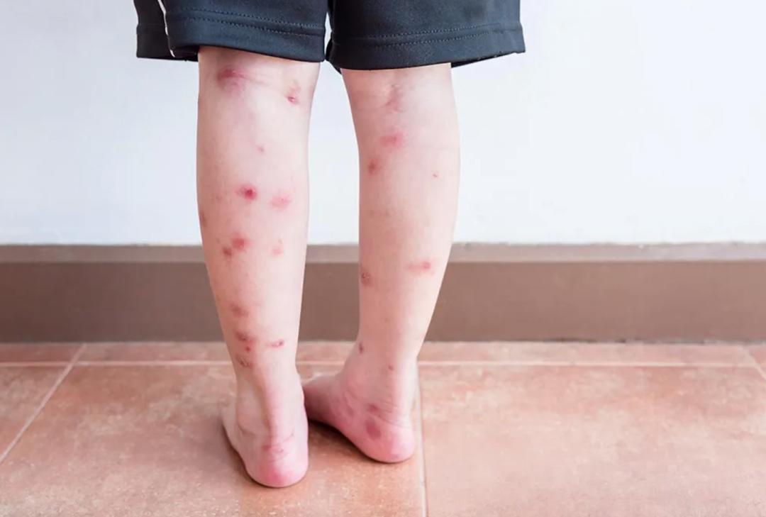 烫伤的紧急处理方法,烫伤紧急处理的第一步是