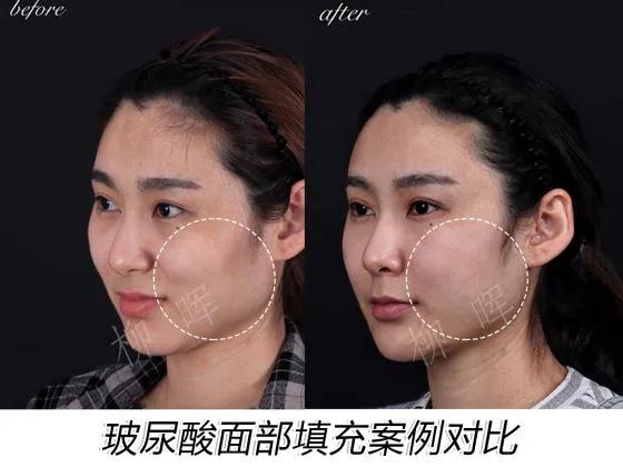 面颊凹陷适合打哪个玻尿酸,脸颊凹陷不饱满