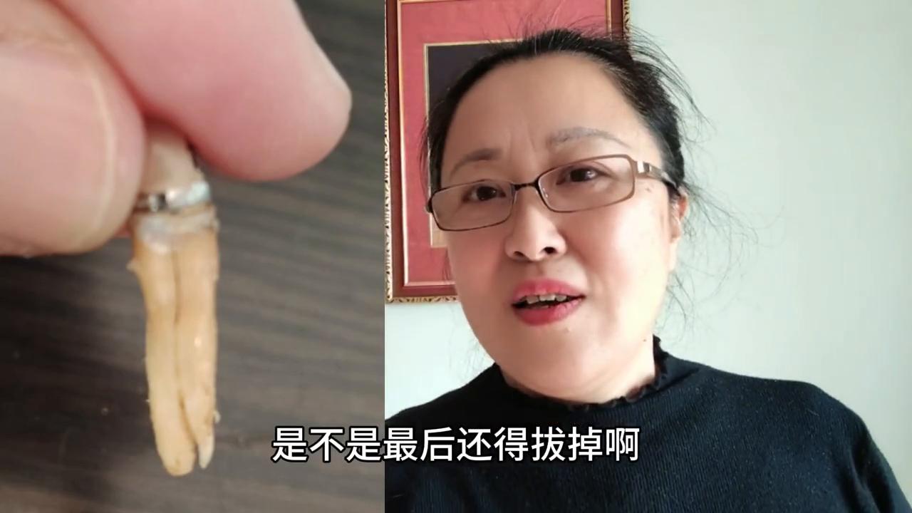 不同医院的同一品牌全瓷牙,牙齿隐裂牙神经挑好还是不挑好