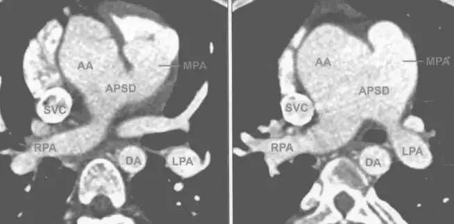 主肺动脉间隔缺损宝宝,主肺动脉间隔缺损的类型有
