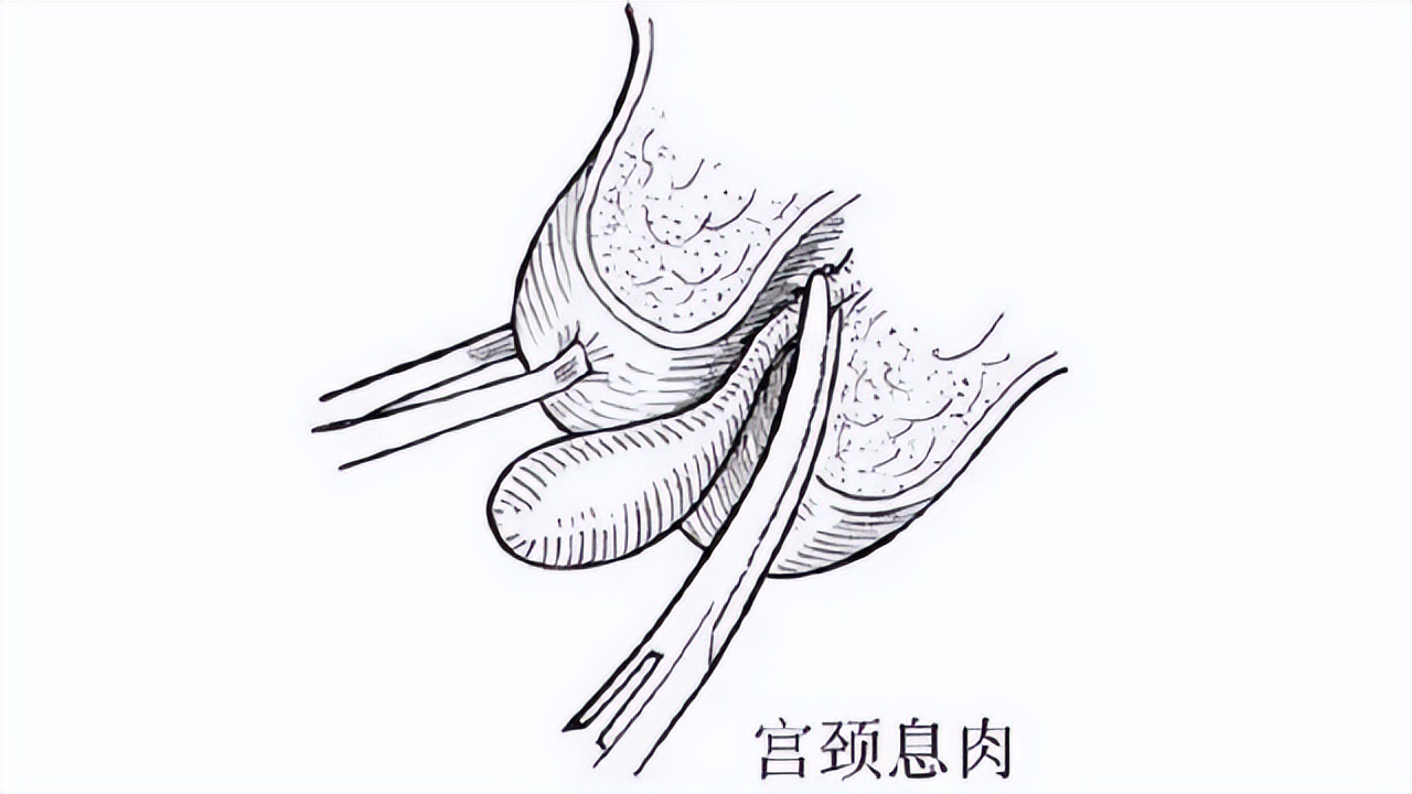 宫颈息肉有必要割掉吗,宫颈息肉需不需要割掉