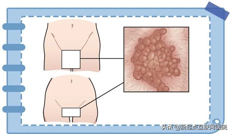 下面长了白色的疙瘩用什么药,下面长红色小疙瘩很痒是什么情况