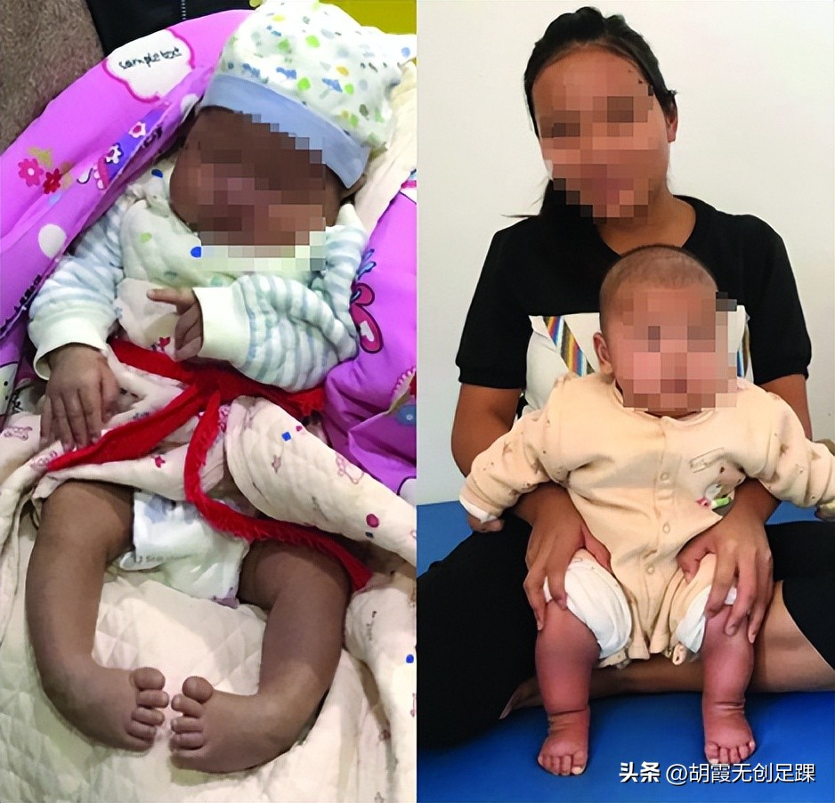 婴儿足内翻是什么样子,什么原因引起婴儿足内翻