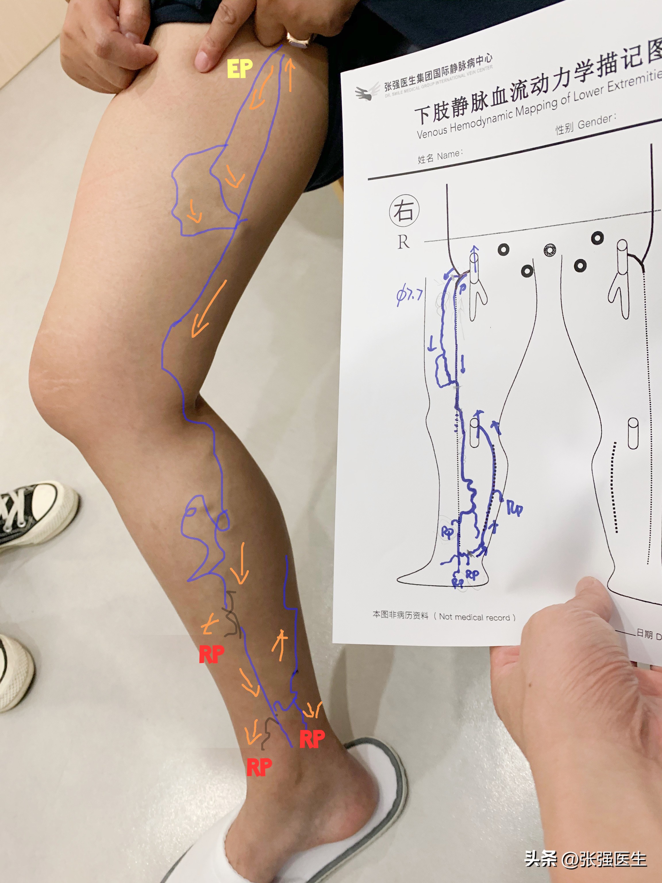 静脉曲张引起小腿肿胀如何治疗,静脉曲张小腿是非凹陷性水肿吗