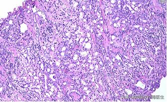前列腺癌psa8,前列腺癌内分泌治疗psa降低至2.75