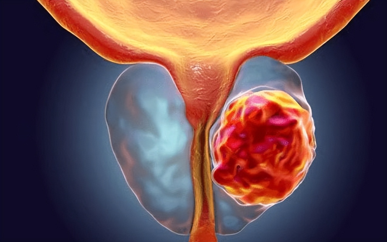 前列腺增生膀胱无力中医治疗秘方,前列腺增生导致尿不尽中药治疗