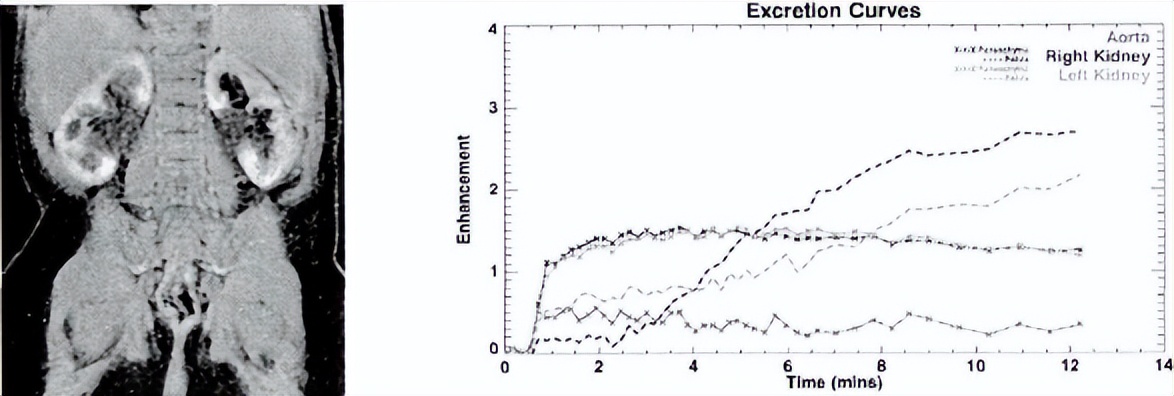 中医治疗宝宝肾积水输尿管狭窄,小儿肾积水和输尿管扩张怎么治疗