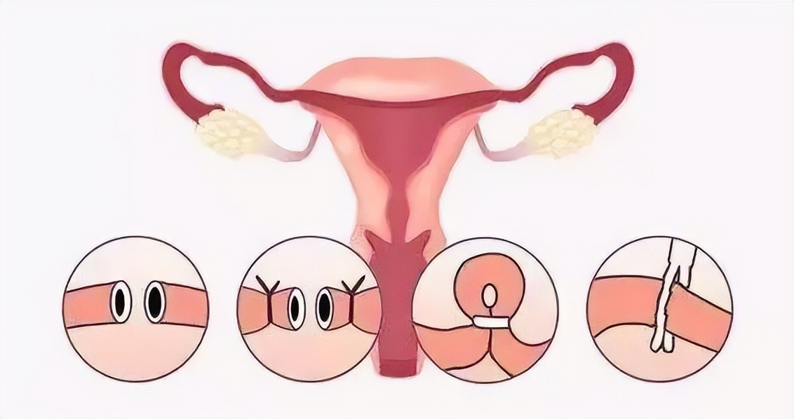 结扎多年后想再孕建议哪种方法,结扎多年还能复通吗