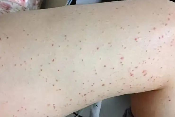 孩子身上出现成片小红点要警惕,儿童身上出现小红点是什么原因