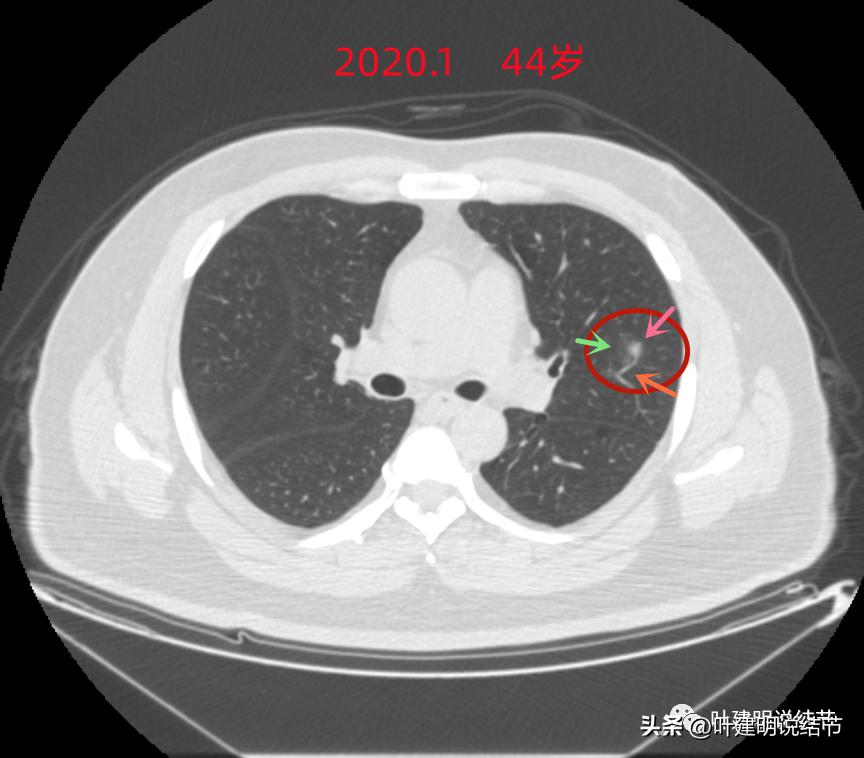如何判断肺磨玻璃结节是高危结节,肺上有混合磨玻璃结节要注意什么