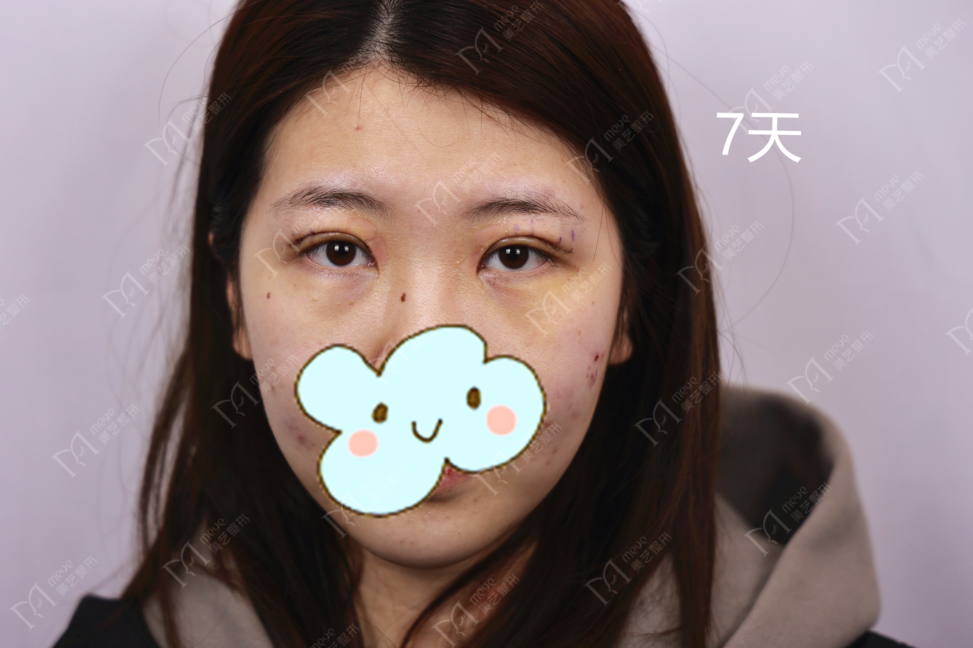 郑州修复双眼皮成功案例,郑州双眼皮修复全过程